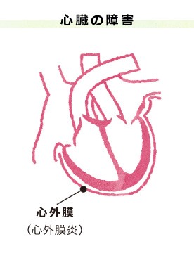 心臓の障害