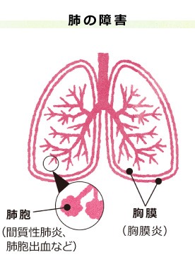 肺の障害